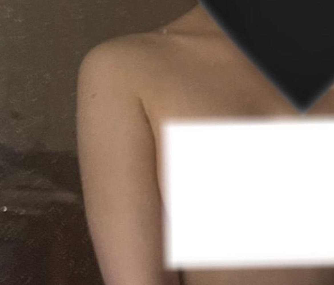 湘南美容クリニック 銀座院で二の腕肩脂肪吸引を受けたひのさんの写真