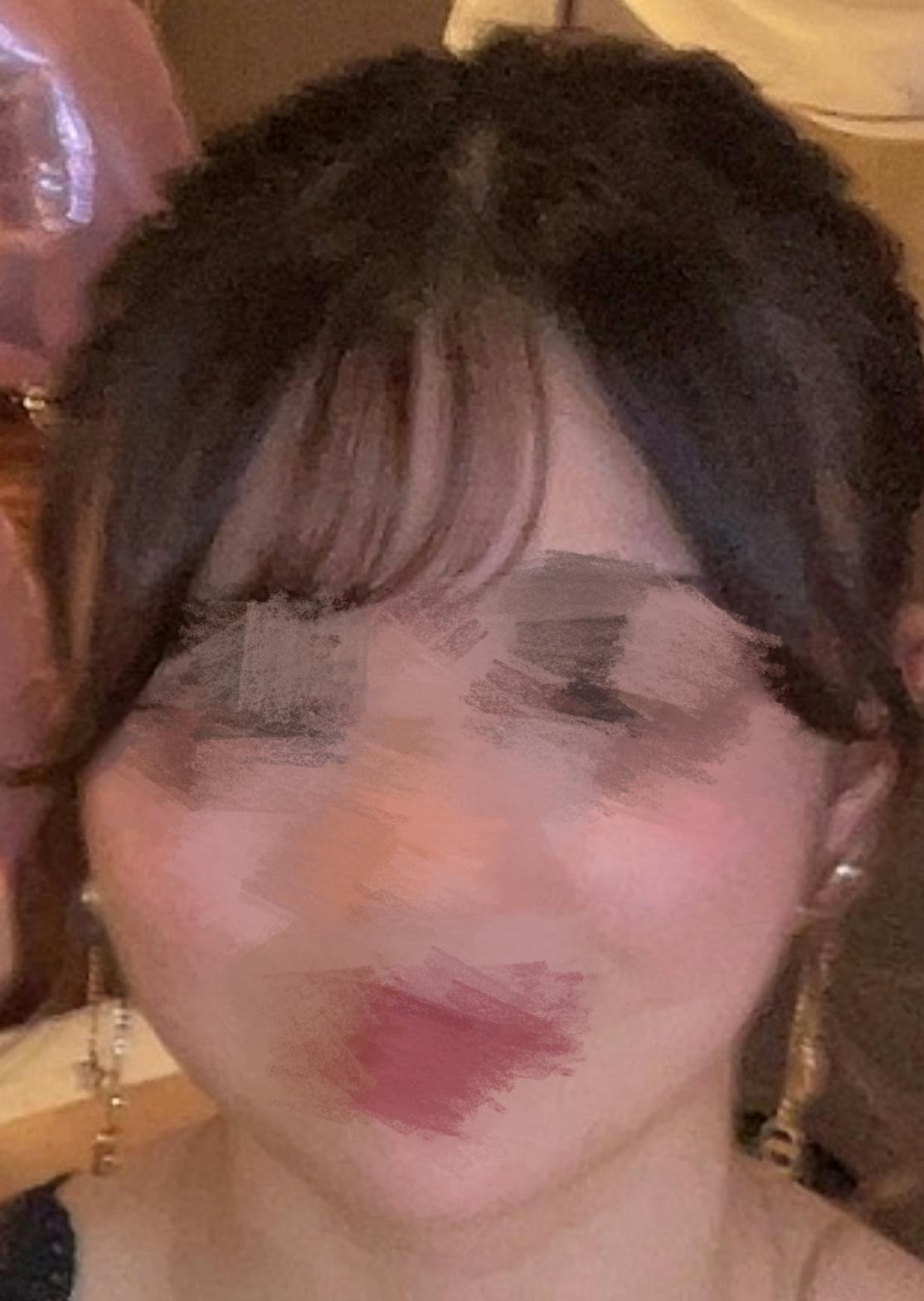 ワムクリニック銀座(WOM CLINIC GINZA)で頬顎下脂肪吸引を受けたすてらさんの写真