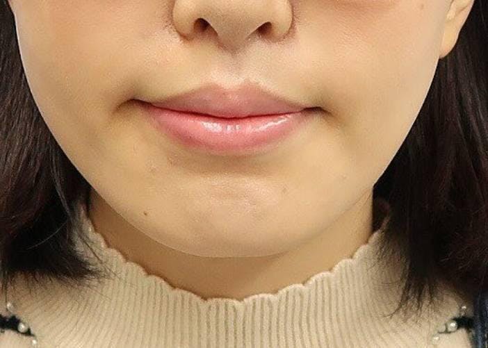 みずほクリニックで耳・耳たぶの整形：立ち耳整形（立ち耳にする整形術）を受けたかー。さんの写真