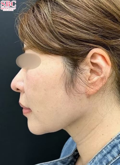 【40代女性・輪郭】美ボディ脂肪吸引_after