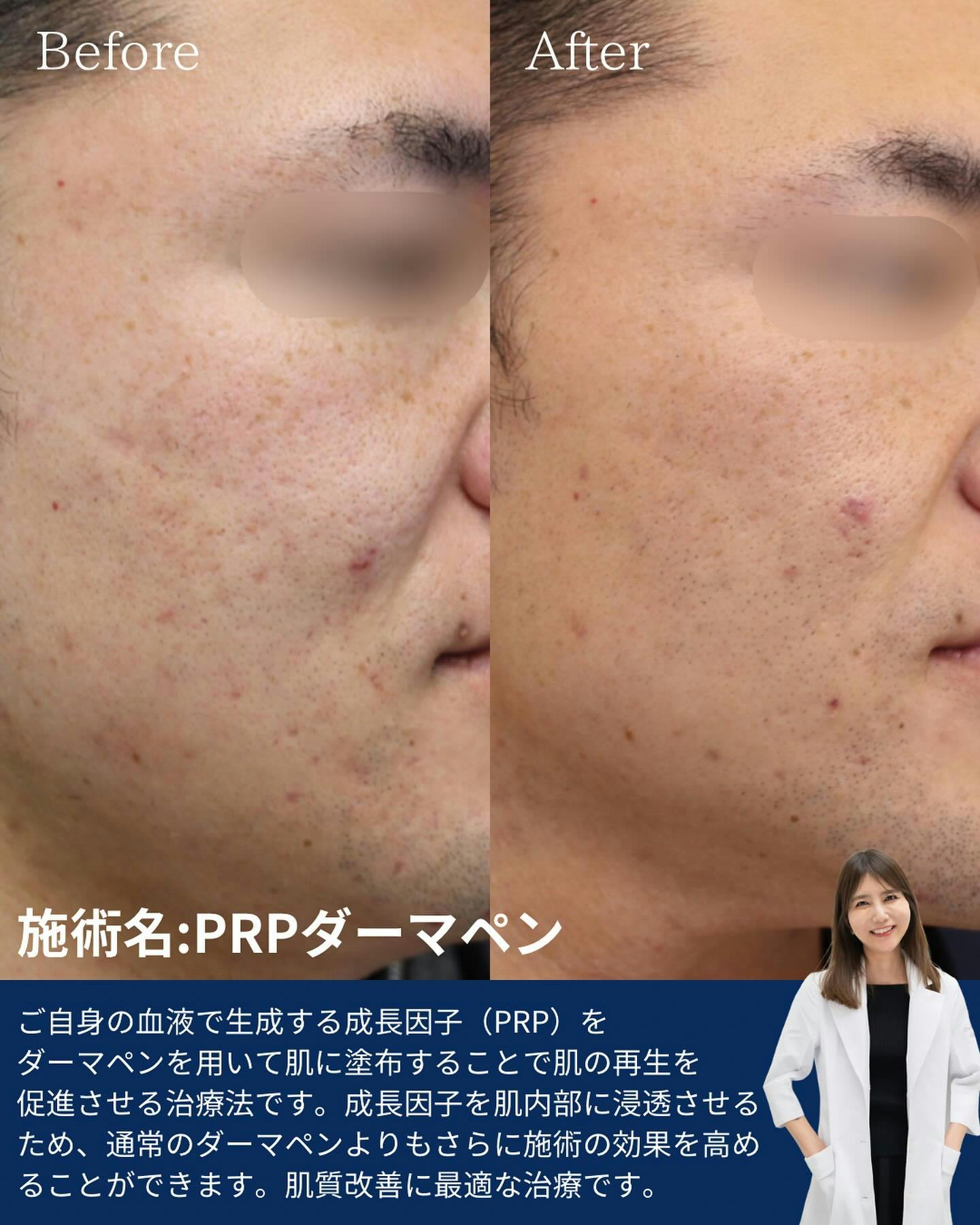 【男性・ニキビ跡】PRPダーマペン_before_aftar