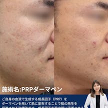 【男性・ニキビ跡】PRPダーマペン_before_aftar