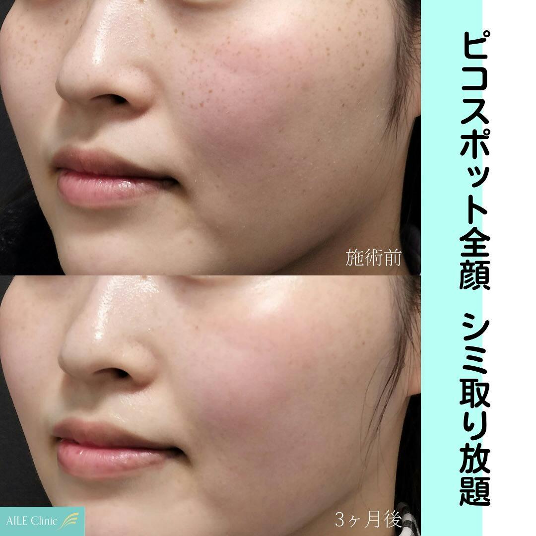 【女性・シミ】ピコスポット全顔_before_aftar