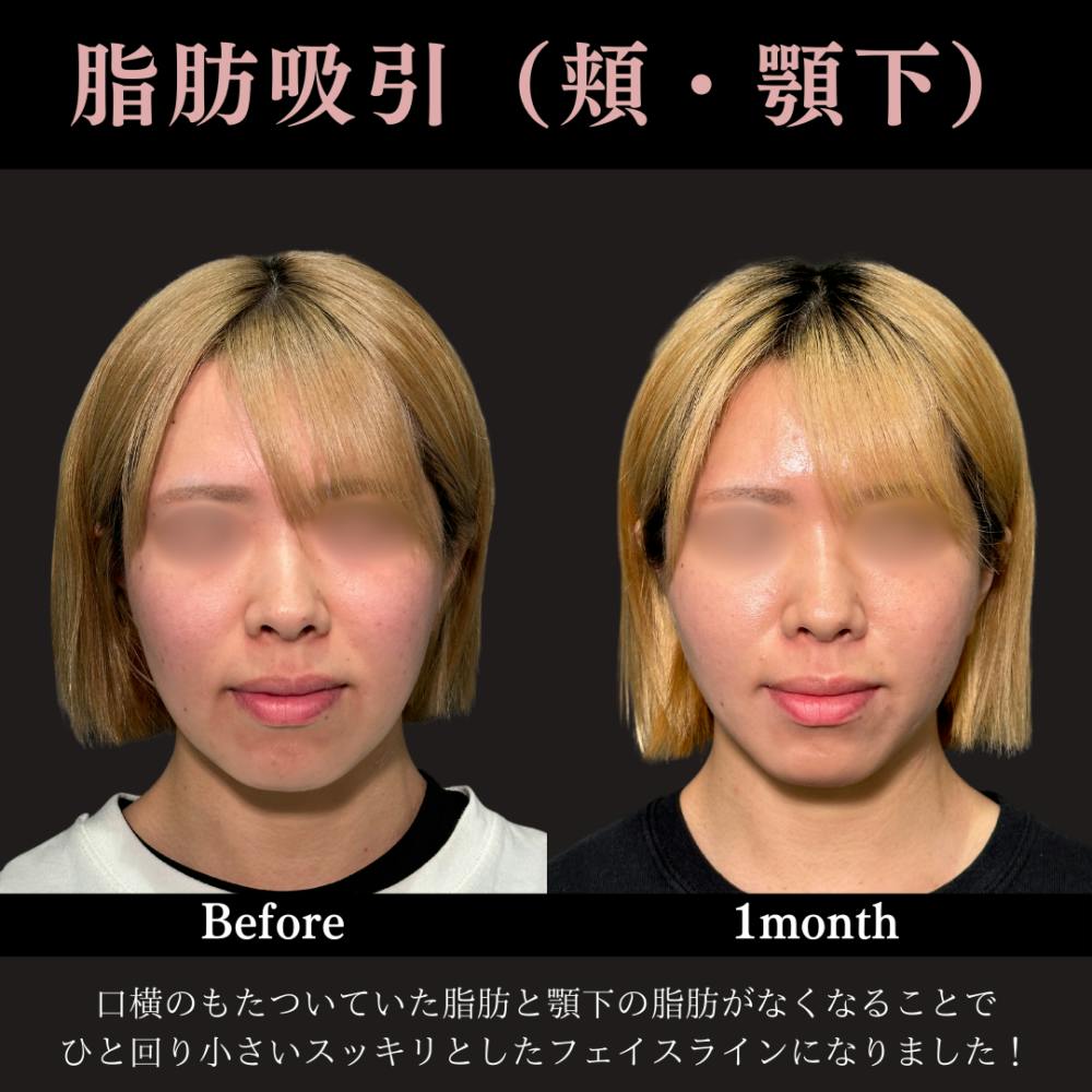 【20代女性・顔】脂肪吸引プレミアム（頬＋あご下）＋PRISMリフト_before_aftar