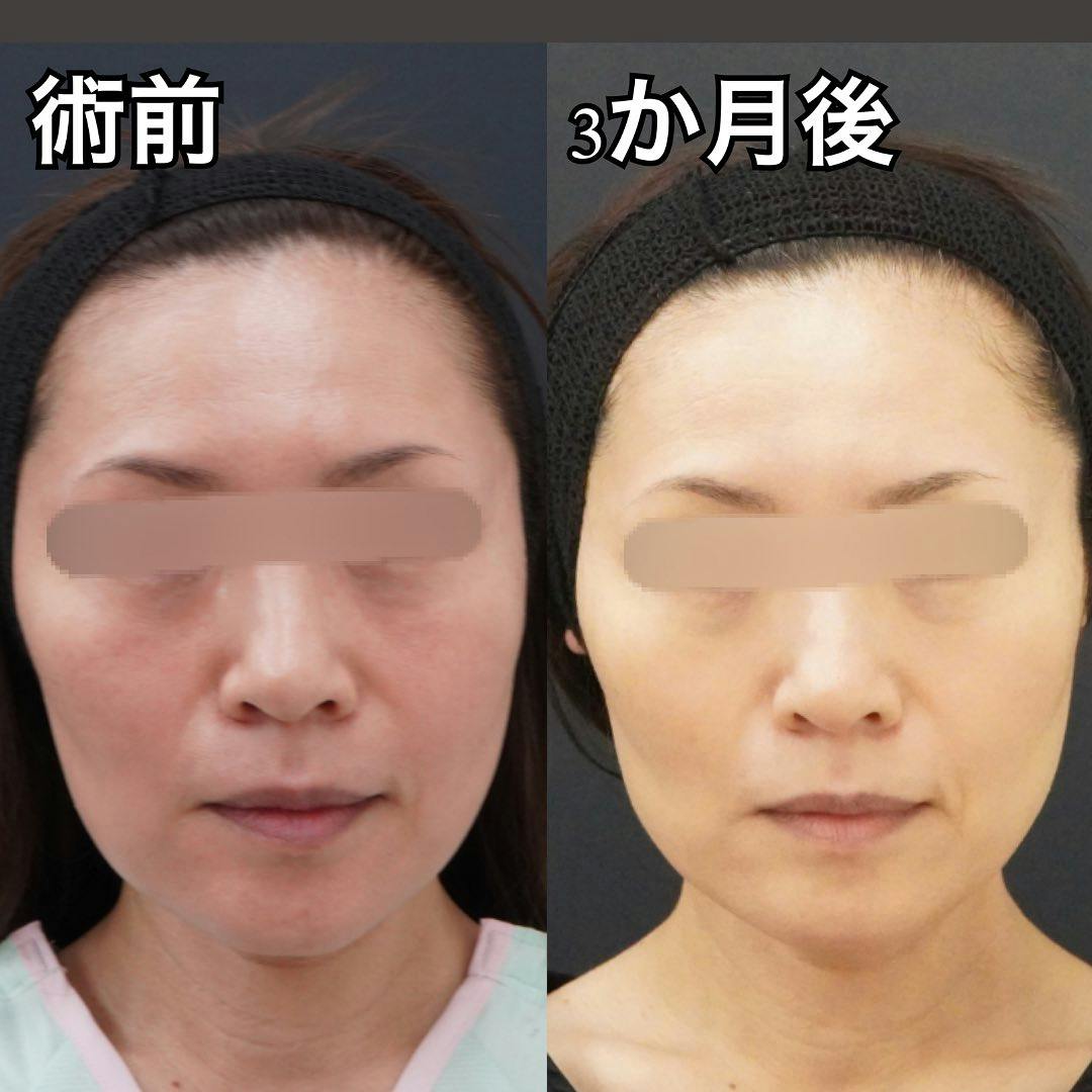 【50代女性・輪郭】二重埋没法_before_aftar