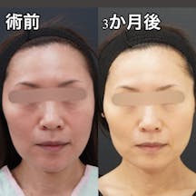 【50代女性・輪郭】二重埋没法_before_aftar