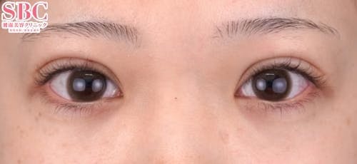 【20代女性・目元】クイックコスメティーク・トリプルNeo_1week