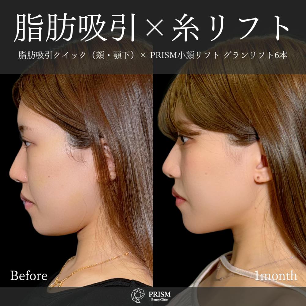 【20代女性・顔】脂肪吸引クイック（頬・あご下）＋糸リフト_before_aftar