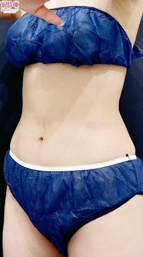 【20代女性・腹部】クールスカルプティング(R)・ エリート（クルスカダブル）_after