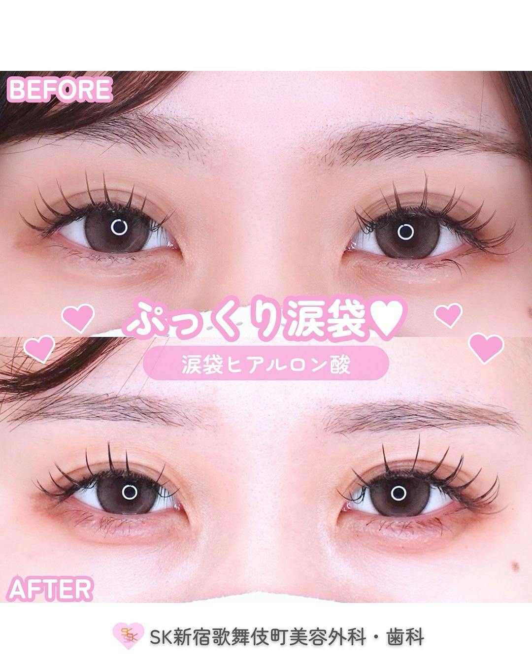 【女性・目元】涙袋ヒアルロン酸_before_aftar