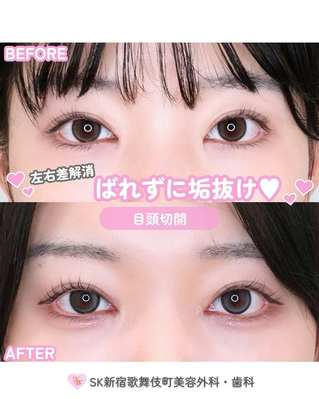 【女性・目元】目頭切開_before_aftar