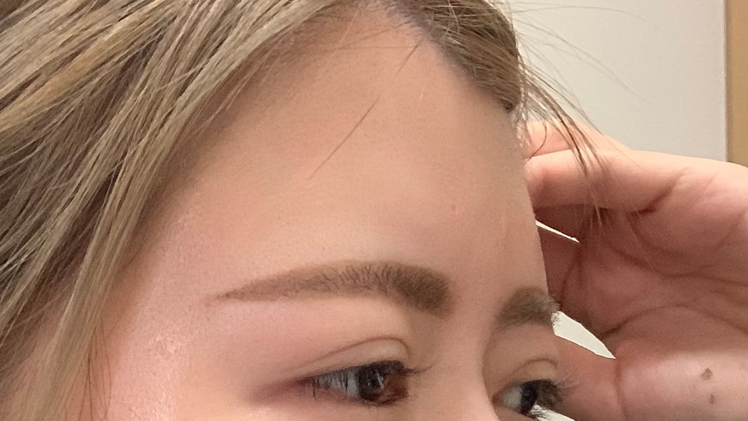 湘南美容クリニック 豊洲院で額脂肪注入を受けたちいさんの写真