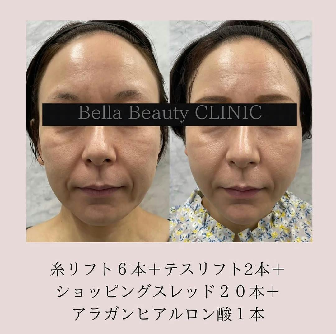 【女性・たるみ】糸リフト　フェイスライン_before_aftar