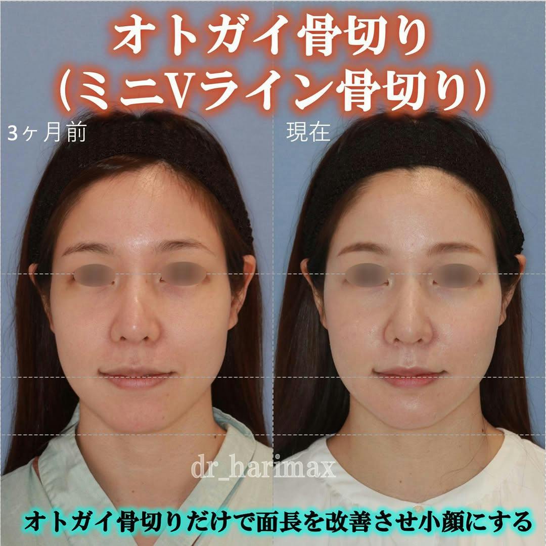 【女性・顎】オトガイ骨切り（ミニVライン骨切り）_before_aftar