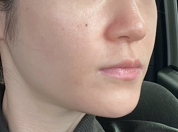 あいち栄クリニックでヒアルロン酸注射・注入を受けたなななさんの写真