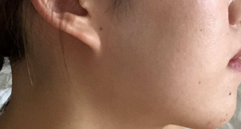 ジュンクリニック(JUN CLINIC)でほくろ取りを受けたSaki9991さんの写真