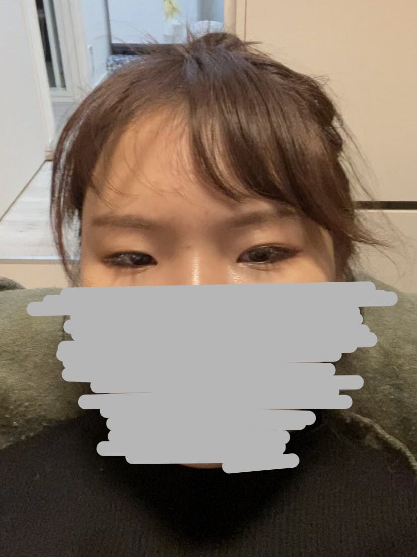 湘南美容クリニック 橋本院で目の下のクマ・たるみ取り（裏ハムラ法）を受けた山藤さんの写真