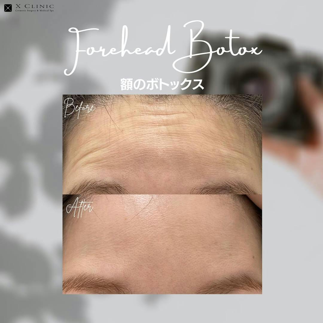 額ボトックス_before_after