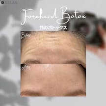 額ボトックス_before_after