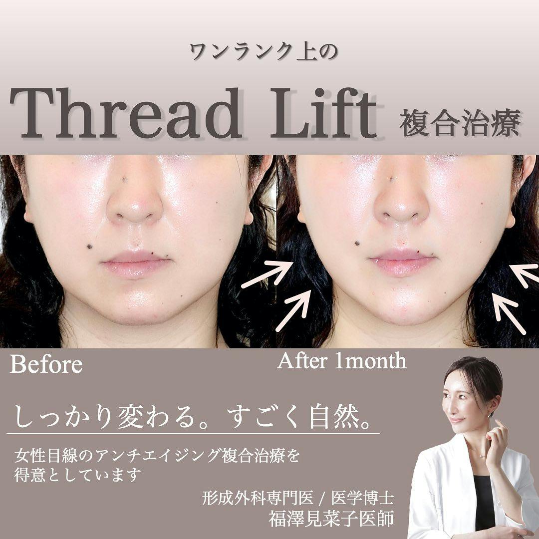 【女性・輪郭】クイックリフト、ヒアルロン酸（顎）_before_aftar