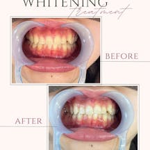 【20代女性・歯】ポリリンホワイトニング_before_aftar