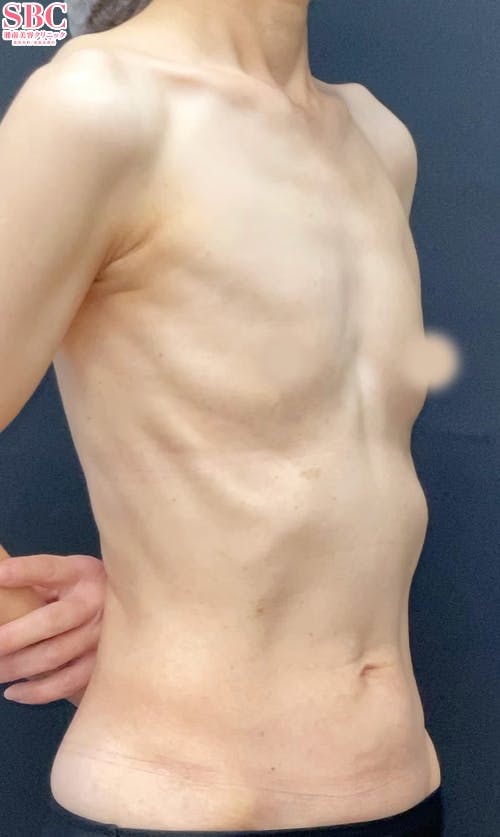 【女性・胸】コンデンスリッチ(脂肪注入豊胸)2回目・Aquicell（アキーセル）併用コンデンスリッチ(脂肪注入豊胸)_before