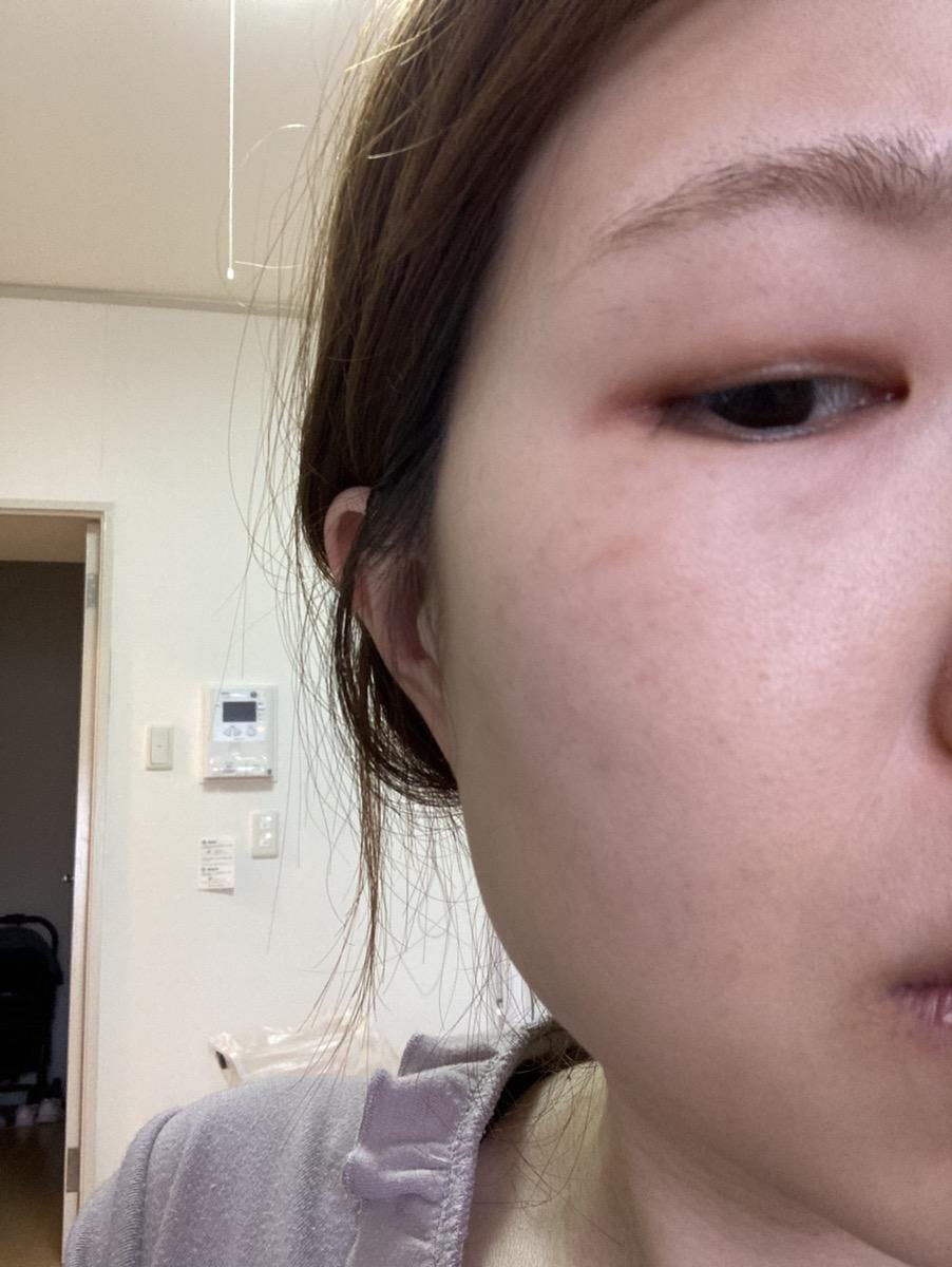 よつば会クリニック 大阪梅田院で美顔+シミ取りコース:美顔+シミ取りコースを受けたさなさんの写真