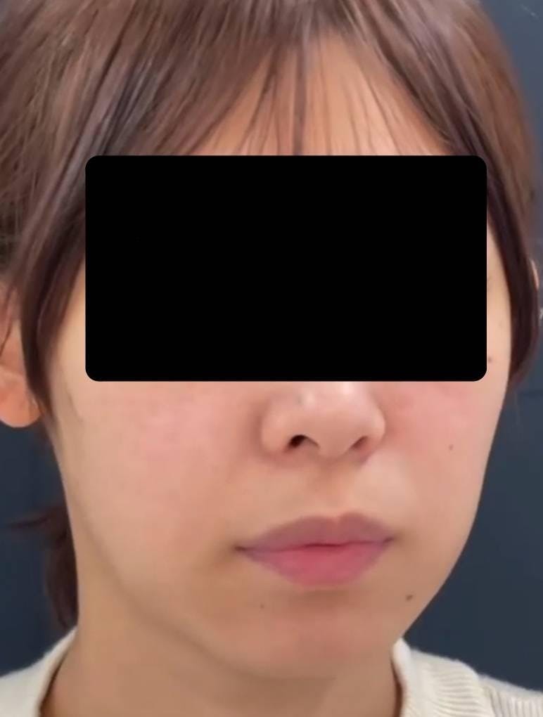 ルラ美容クリニック 渋谷本院で口元・唇の整形：人中短縮術を受けた葵さんの写真