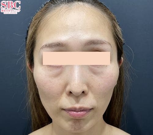 【女性・輪郭】コンデンスリッチフェイス脂肪注入全顔入れ放題、目の下の切らないクマ・たるみ（ふくらみ）取り、ナチュラル脂肪注射ナノリッチ_before