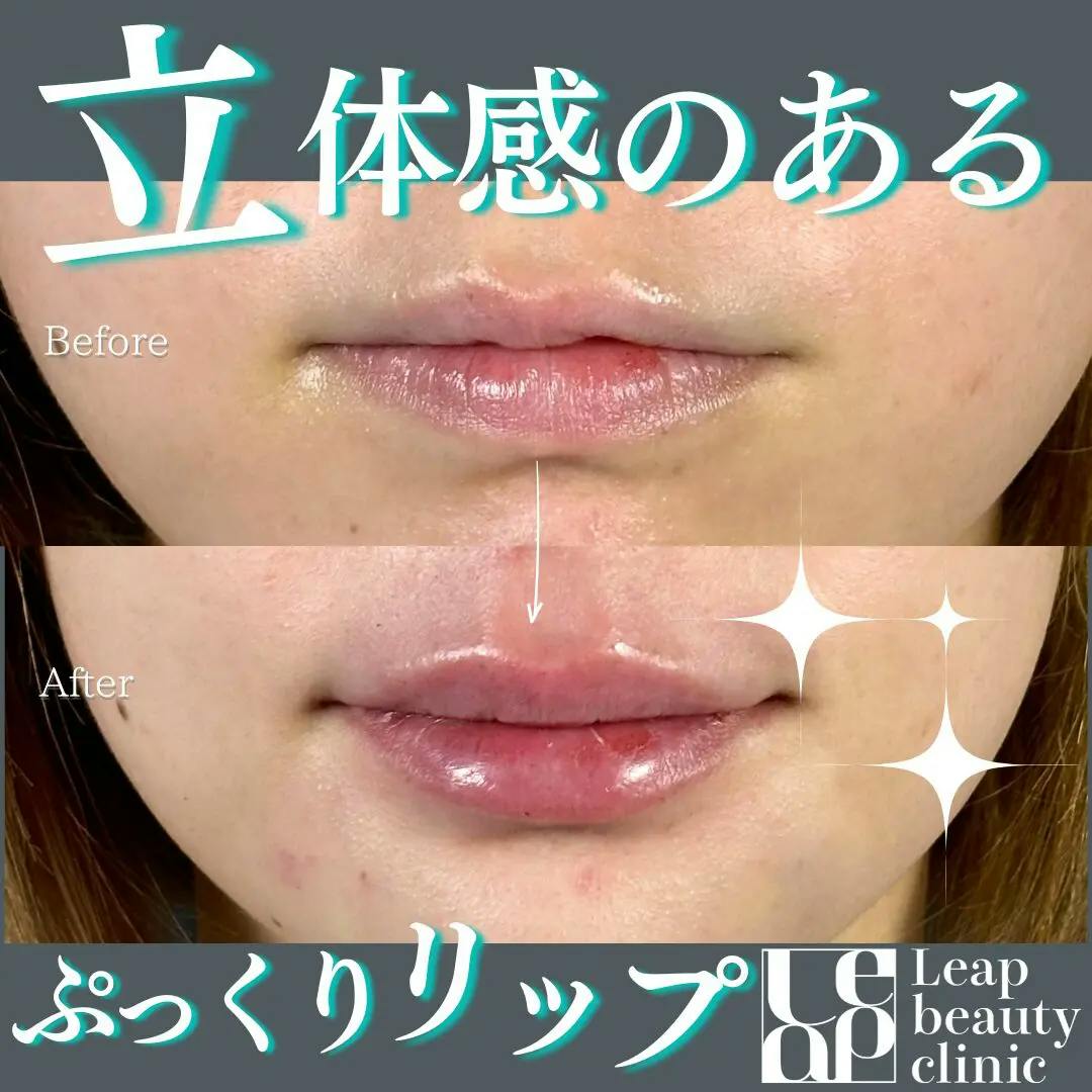 【20代女性・口元】唇ヒアルロン酸・口角ボトックス_before_aftar