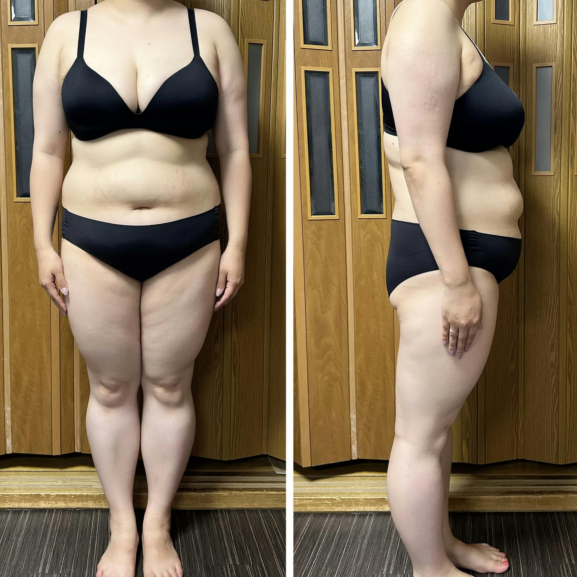 湘南美容クリニック 大阪梅田本院で医療痩身・ダイエット・GLP-1・サクセンダを受けたnaagiiさんの写真