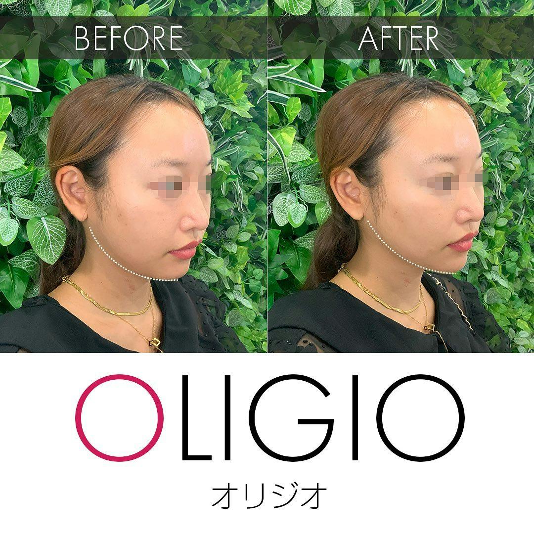 【女性・たるみ】リフトアップ(オリジオ)_before_aftar