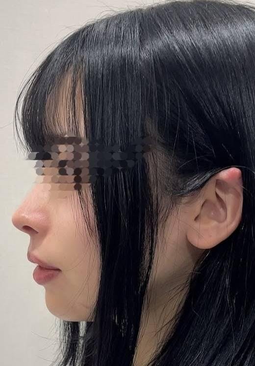 聖心美容クリニック 銀座院で鼻の整形：鼻尖縮小を受けたつー子さんの写真