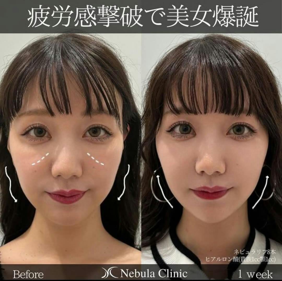 【女性・顔・小鼻・顎】糸リフト、ヒアルロン酸注入(貴族・顎)_before_aftar