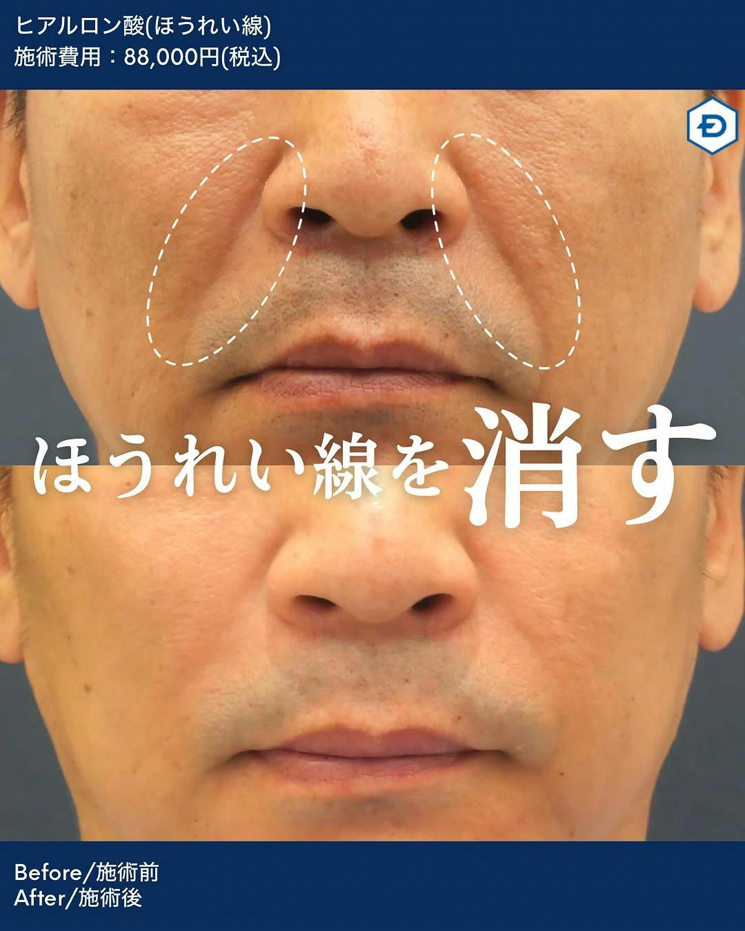 【男性・ほうれい線】ヒアルロン酸注入(ほうれい線)_before_aftar