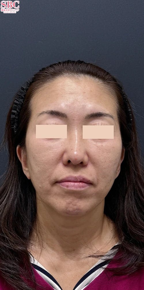 【女性・輪郭】VOV（ボブ）リフト、シークレットリフト、テスリフト_before