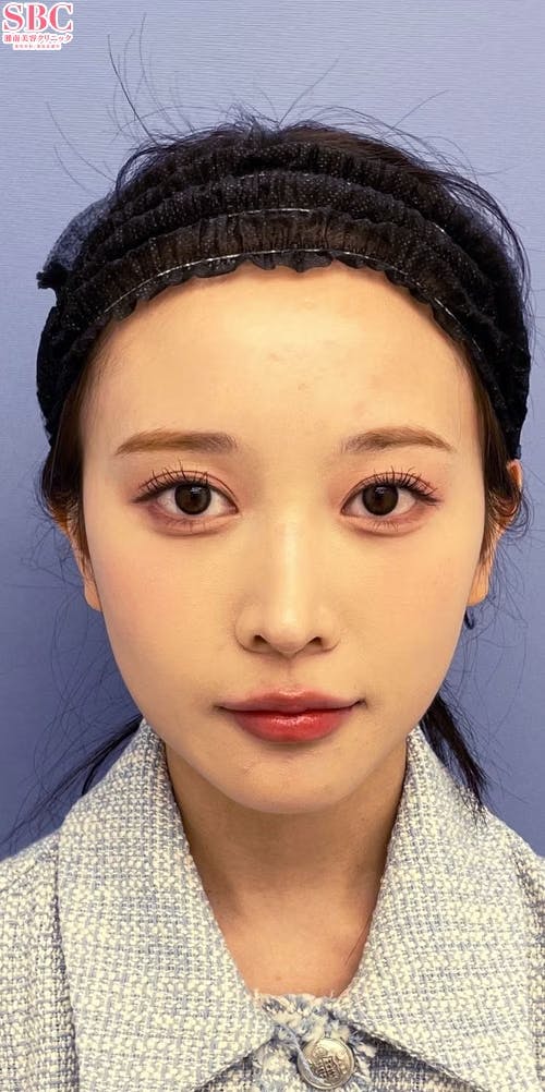 【女性・輪郭】Aquicell（アキーセル）脂肪吸引、根こそぎVASER脂肪吸引、ジョールファット除去術_aftar