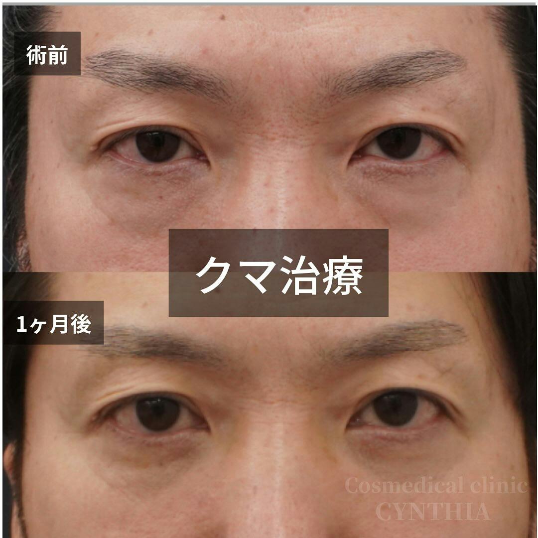 【男性・目元】目の下のクマ取り_before_aftar