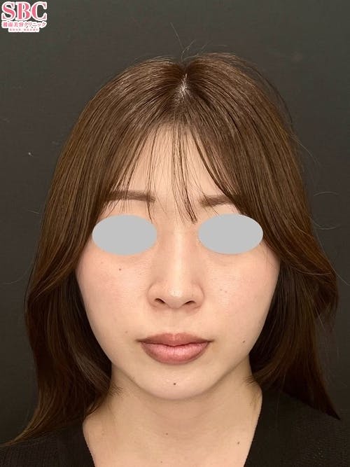 【20代女性・輪郭】プリマリフト_after