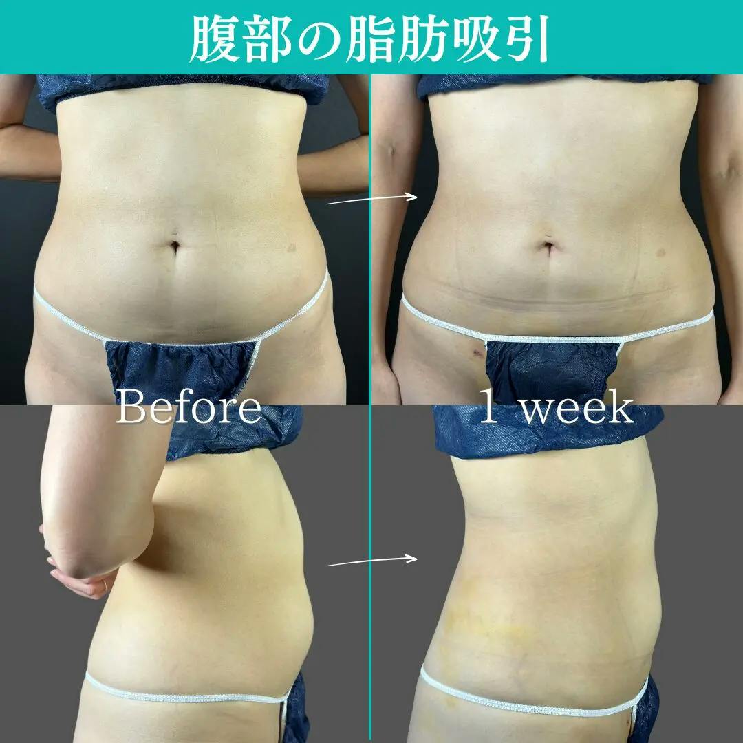 【30代女性・腹部】腹部脂肪吸引_before_aftar