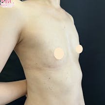 【女性・胸】週末豊胸 -ピュアグラフト-(脂肪注入豊胸)_before