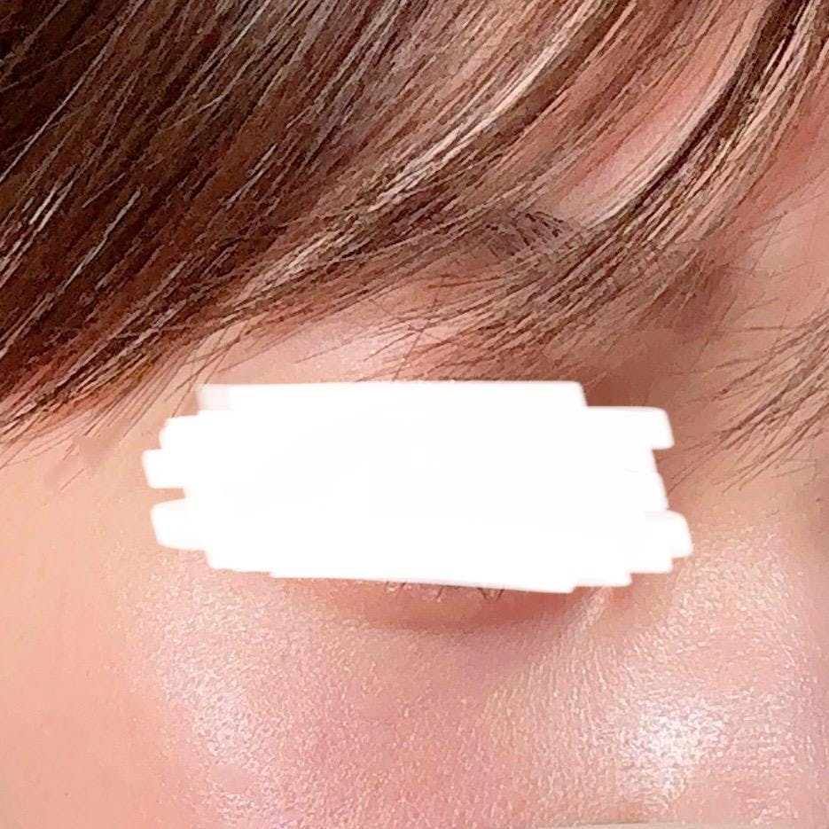 【閉院】品川美容外科札幌院でシミ取り：Qスイッチヤグレーザーを受けたみいさんの写真