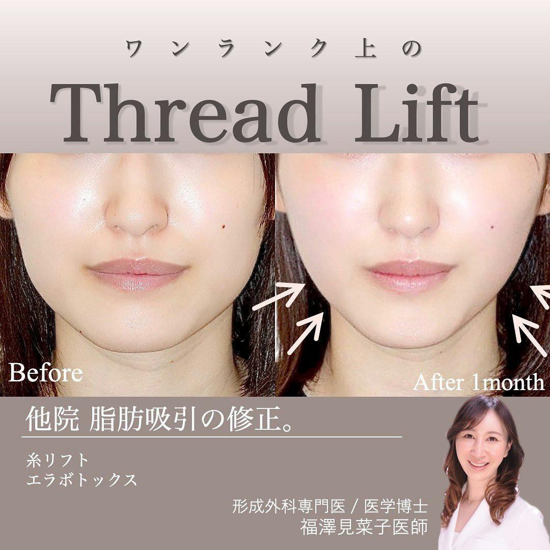 【女性・輪郭】糸リフト、エラボトックス_before_aftar