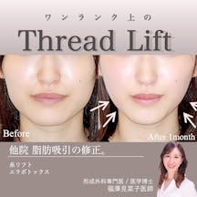 【女性・輪郭】糸リフト、エラボトックス_before_aftar