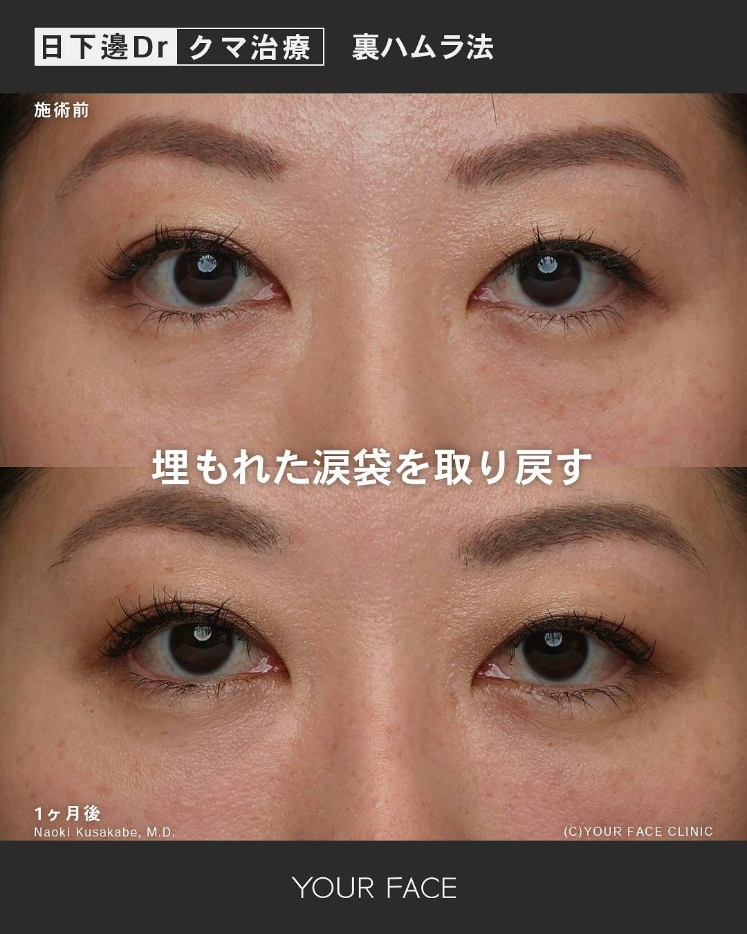 【女性・クマ】裏ハムラ法_before_aftar