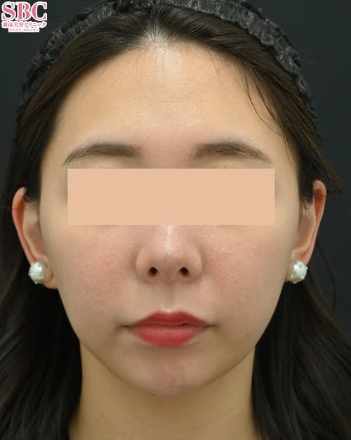 【女性・口元】切らない人中短縮_aftar