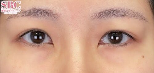 【女性・目元】クイックコスメティーク・ダブルNeo 下眼瞼下制（結膜切開法）_before