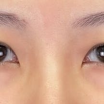 【女性・目元】クイックコスメティーク・ダブルNeo 下眼瞼下制(結膜切開法)_before