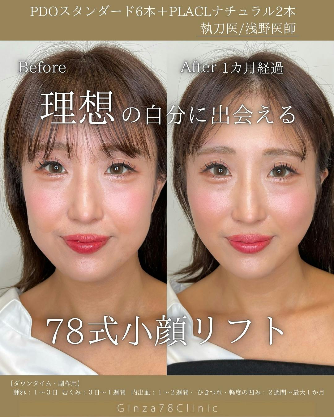 糸リフト(スレッドリフト)の症例写真・ビフォーアフター画像No