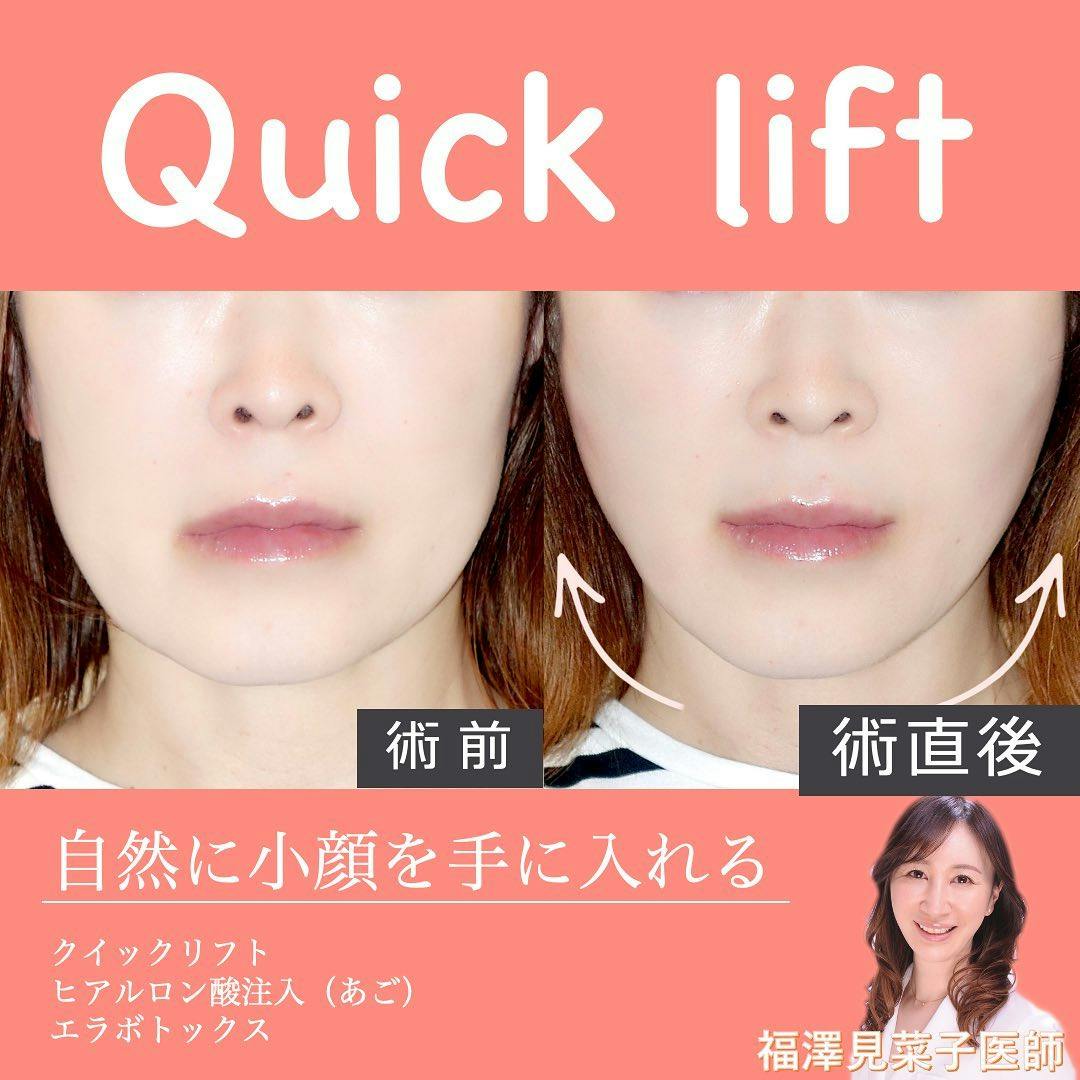 【女性・小顔】クイックリフト、エラボトックス_before_aftar